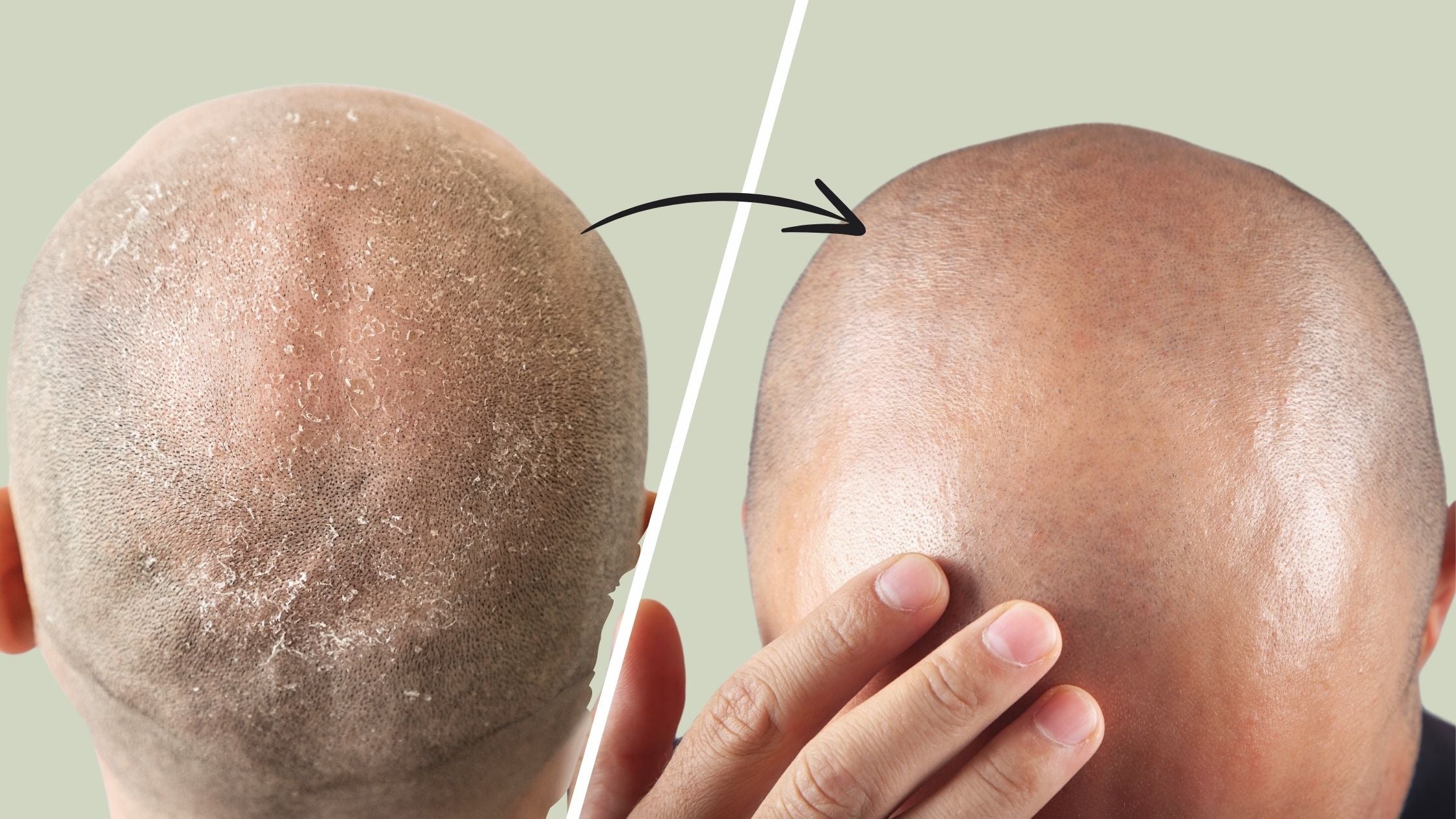 Bald Head Essentials: 5 Ways These Moisturizers Elevate Bald Head Care
